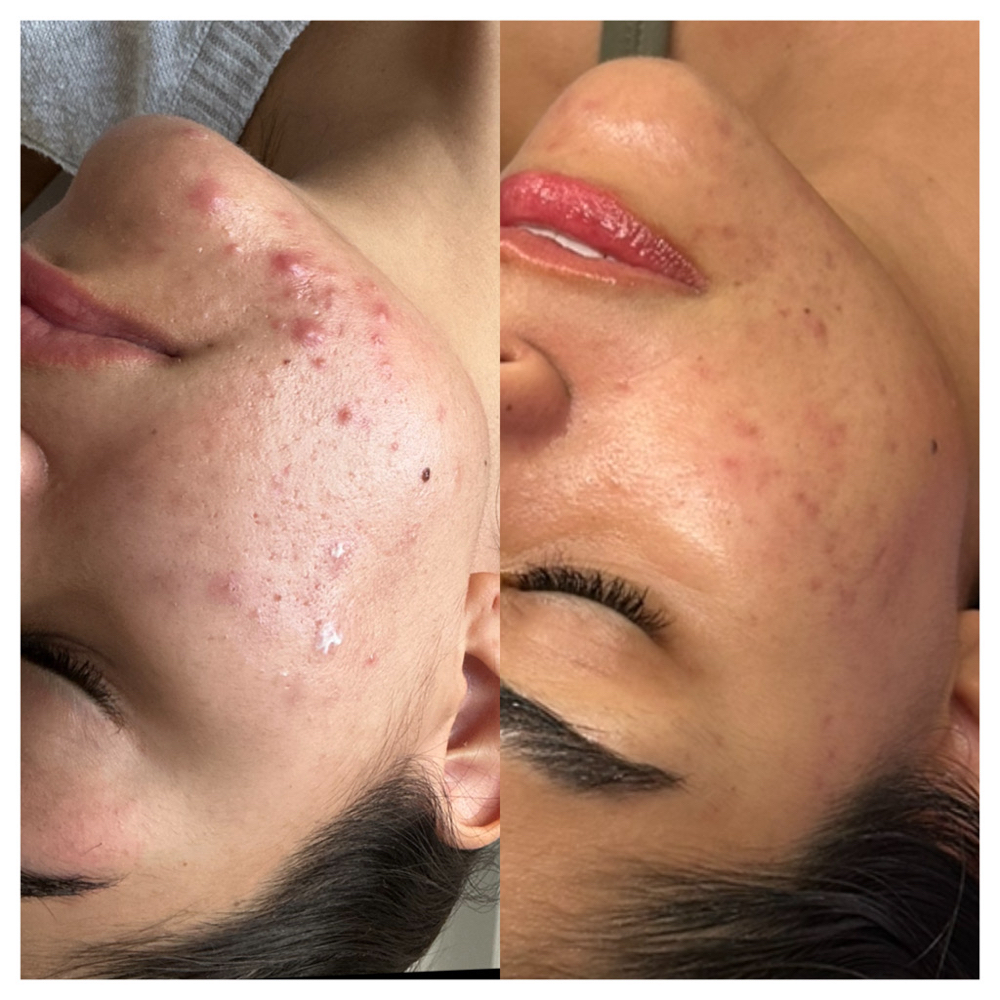 Acne Coach (1st Time Client)