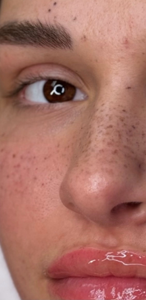 Permanent Freckles