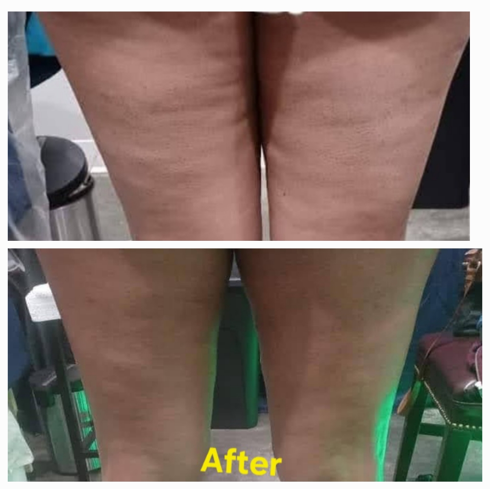 Smooth & Sculpt Cellulite Treatment