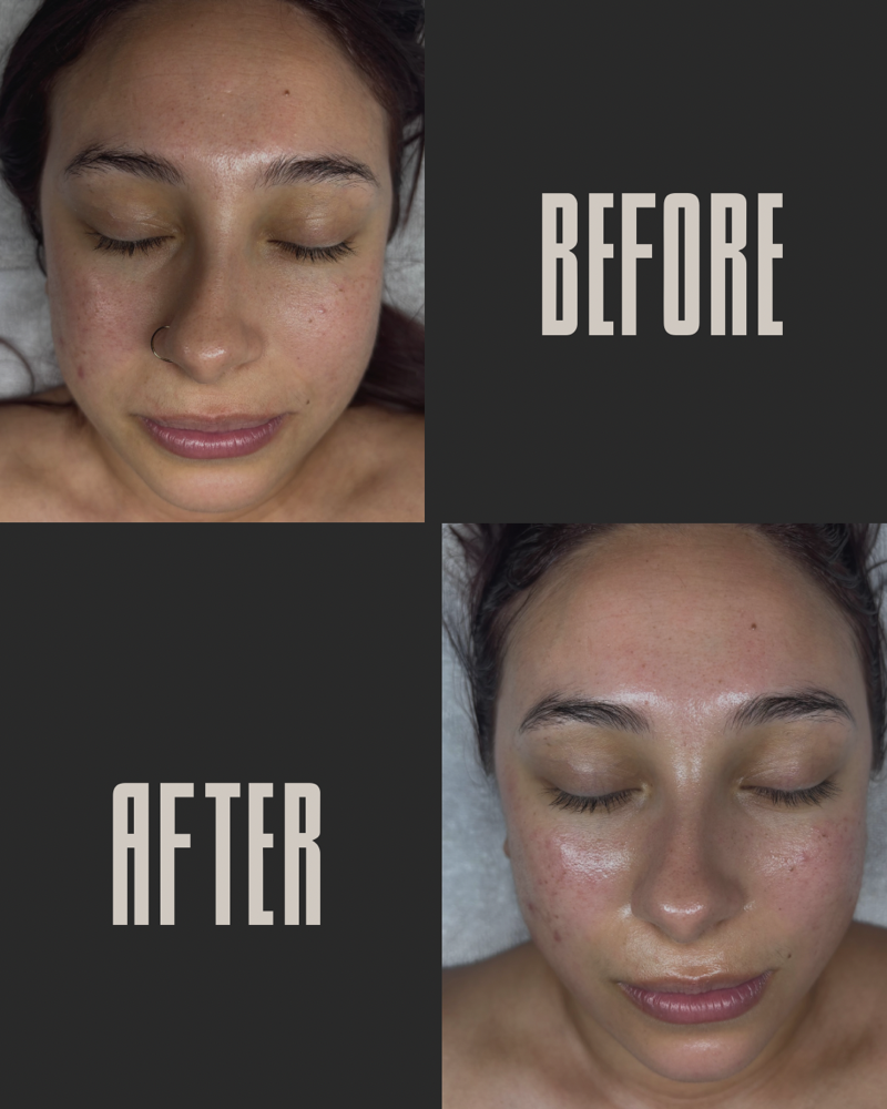 Deep clean Hydro-facial