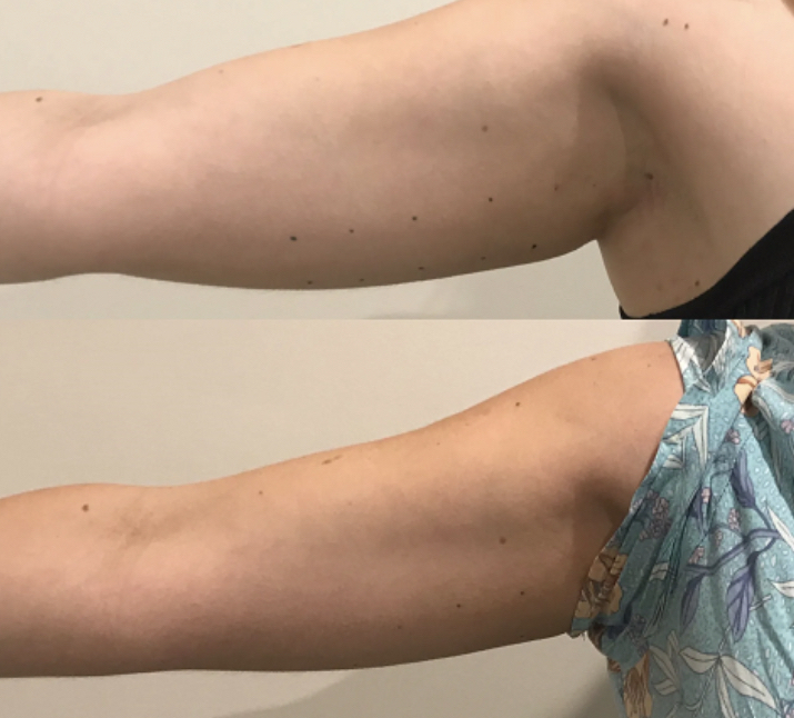 Skin Tightening: Arms at Mia Glow in Shelby Township, MI