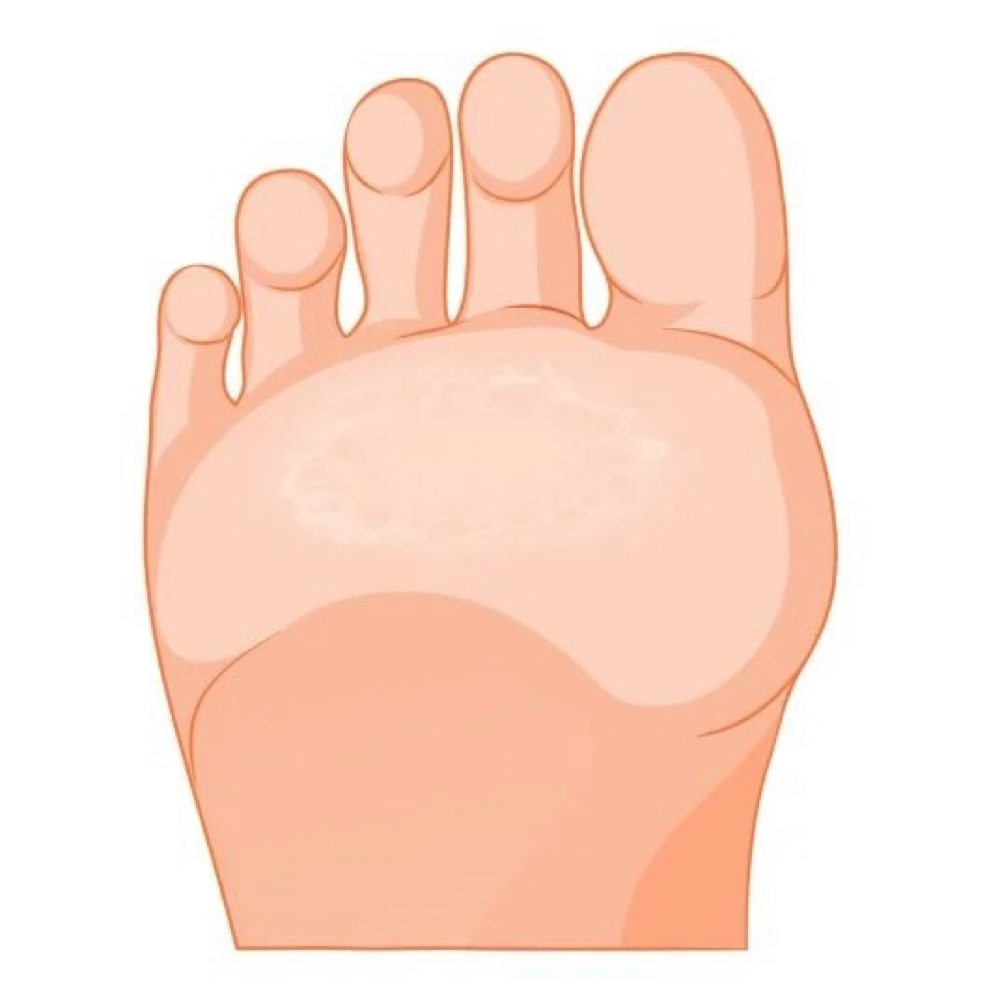 Callus treatment at Daisy Nail & Spa in Newcomerstown, OH