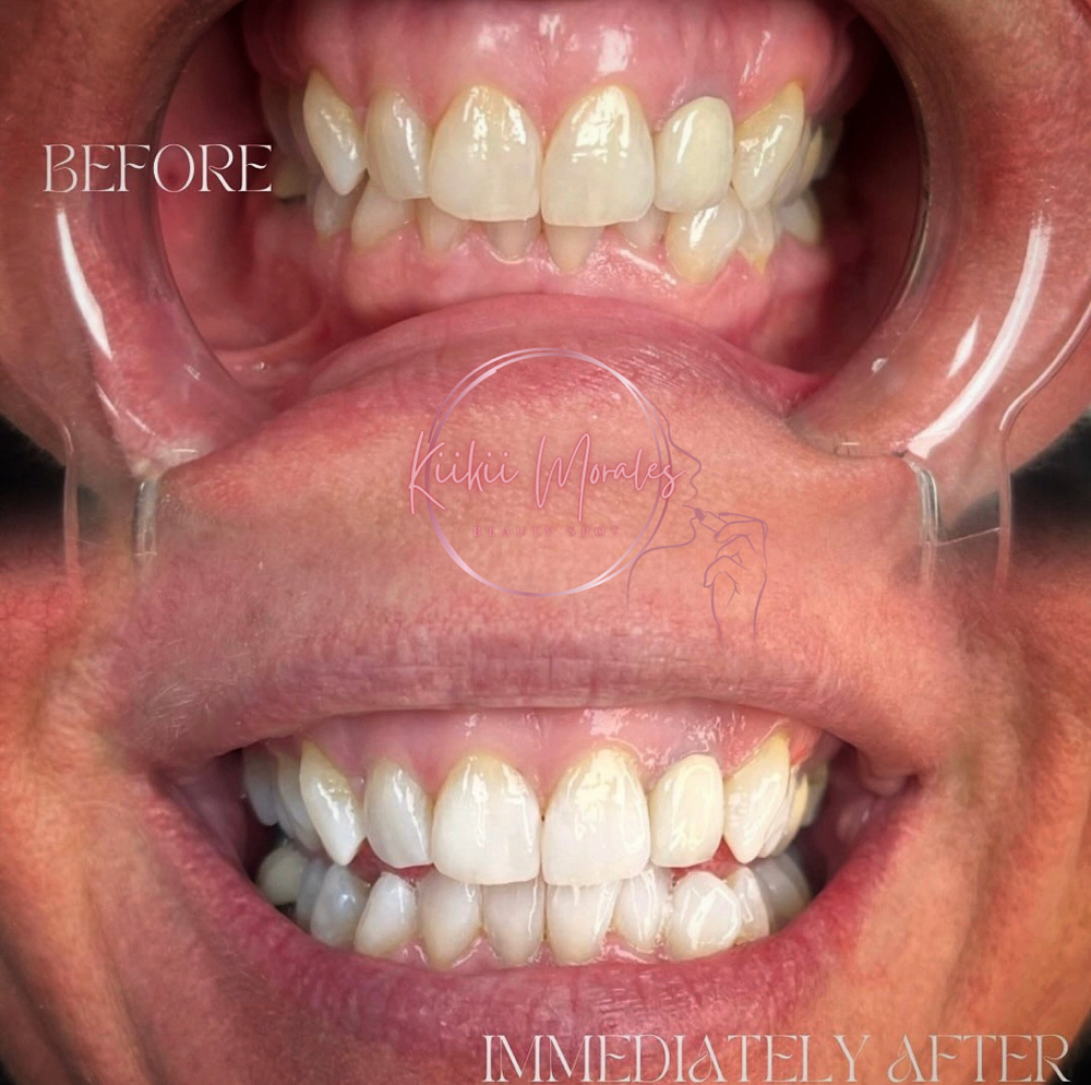 Teeth Whitening Menu