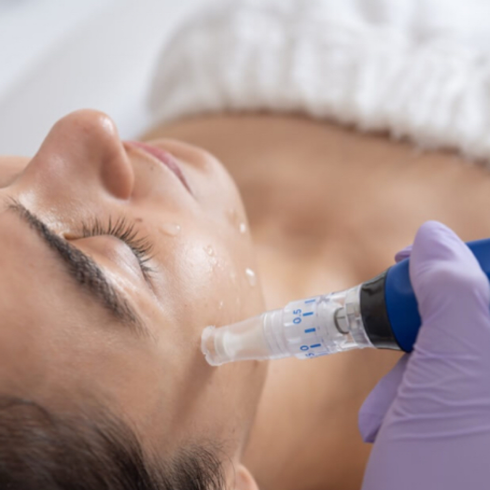 Microneedling (Package of 3) at Glowbar in Prescott, AZ