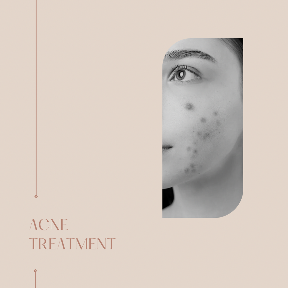 Acne Facial