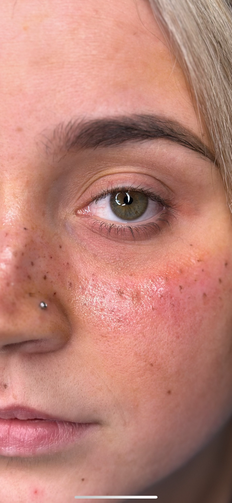 Tattooed 3D Freckles