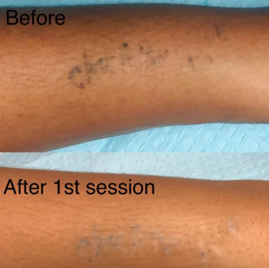 Tattoo Removal