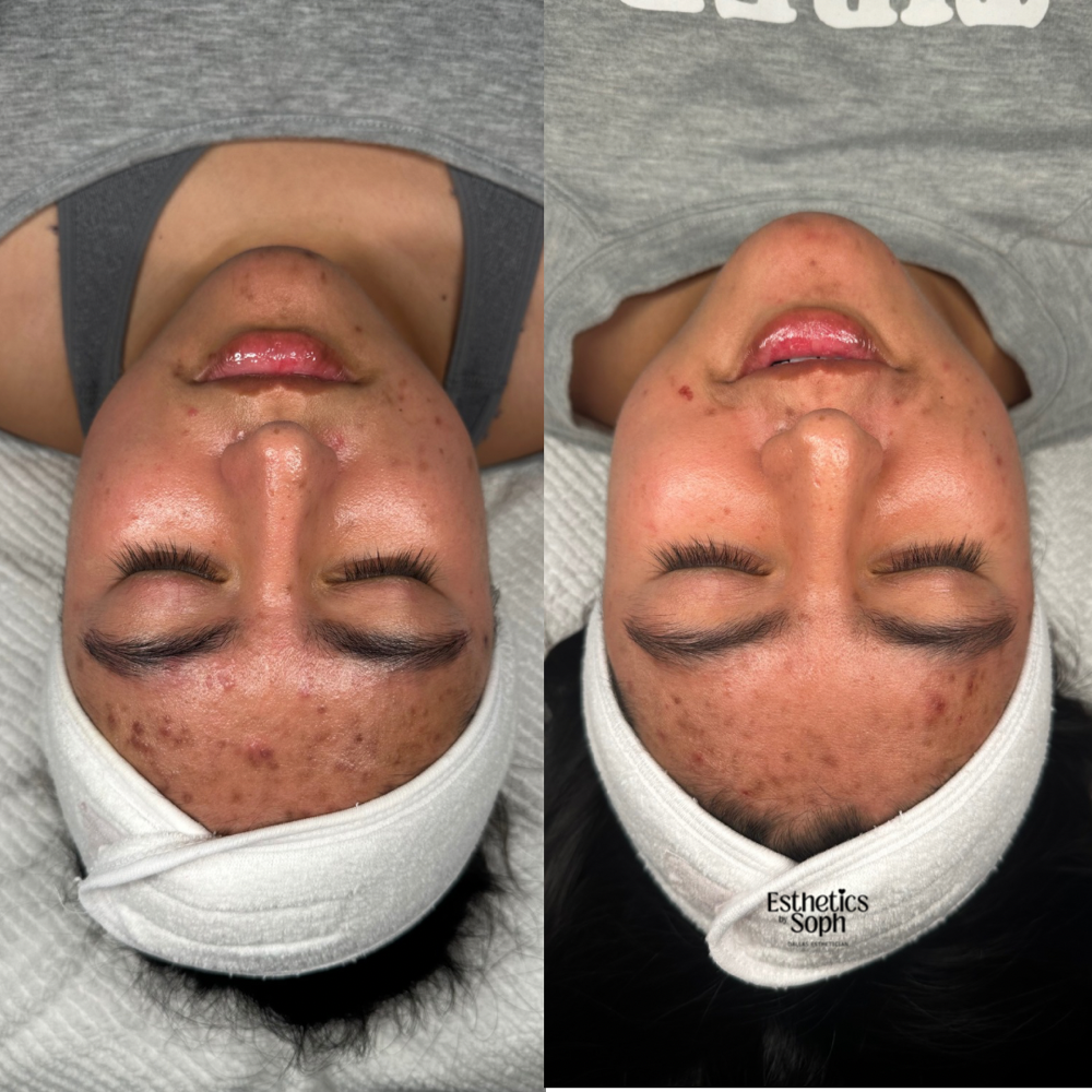 Brightening Facial