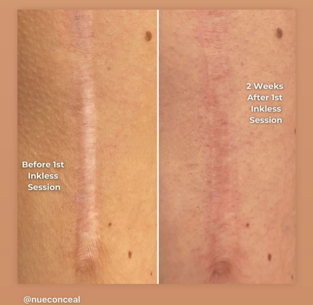 Scar Removal
