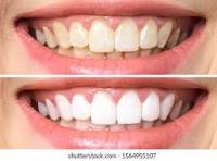 Teeth Whitening 2 Sessions
