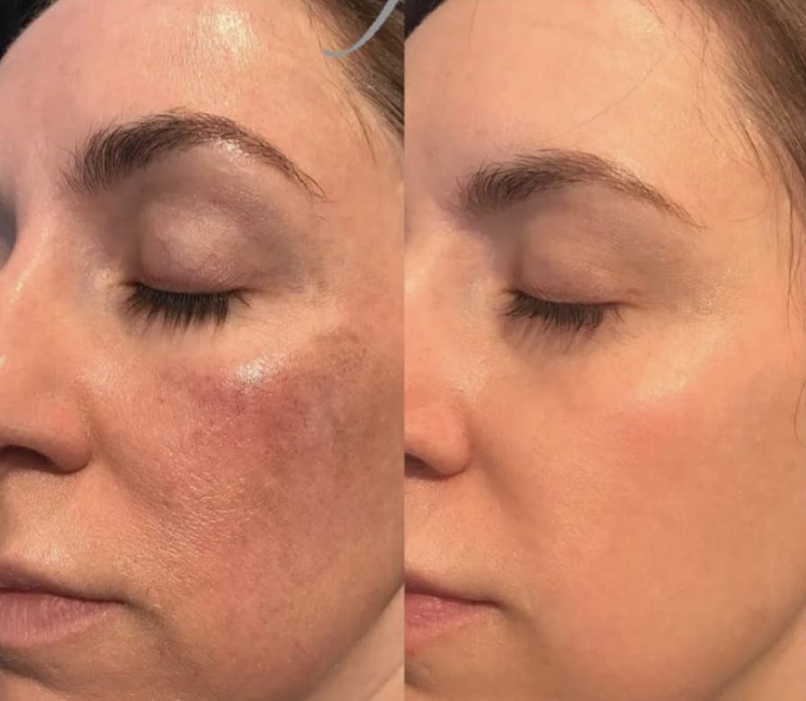 Peeling Glicolic, TCA, Jesnner