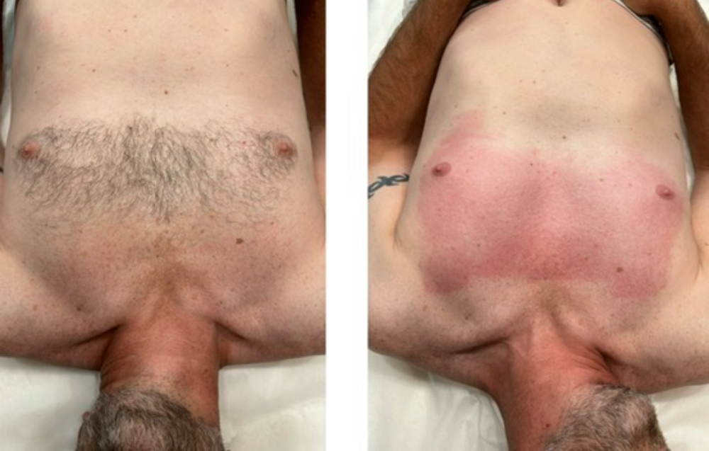 Chest Wax