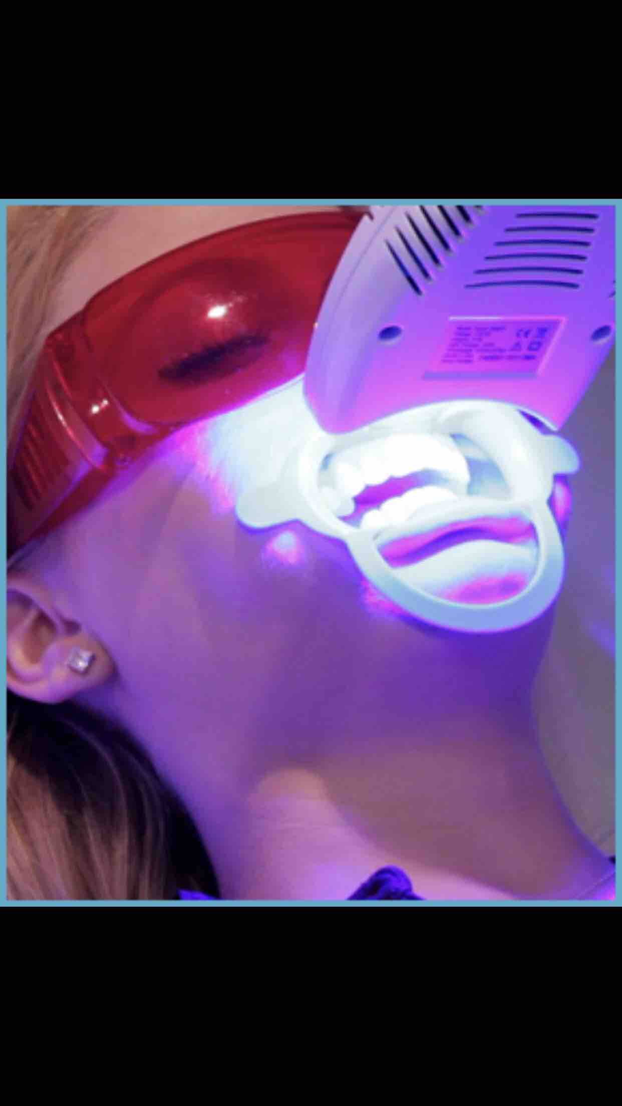 Teeth Whitening