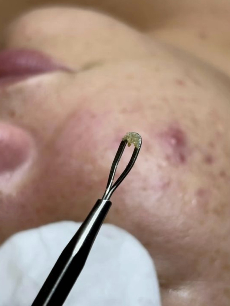 Acne Clearing Facial at Ginnette Studio in Torrance, CA