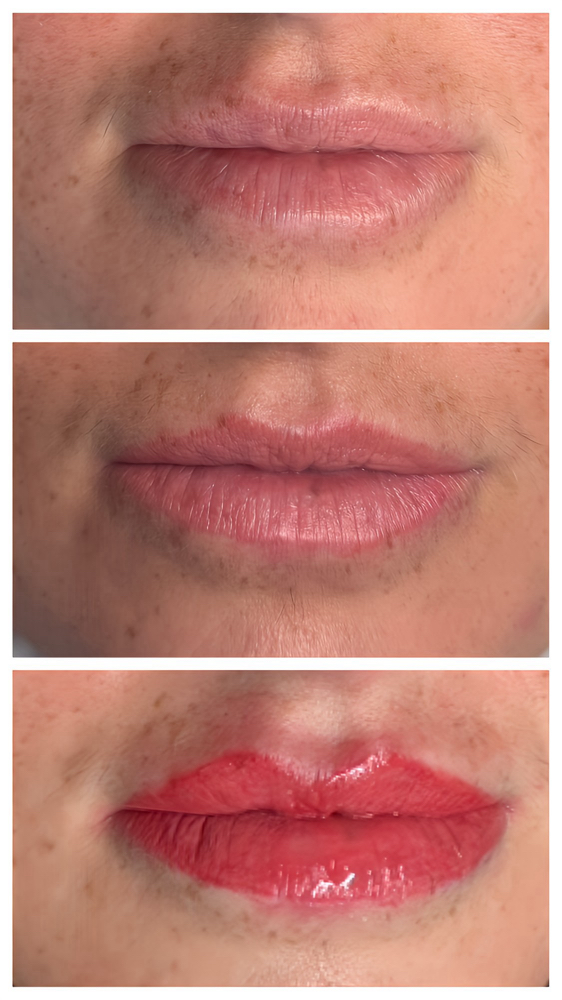 Lip Shape Correction With Lip Blush