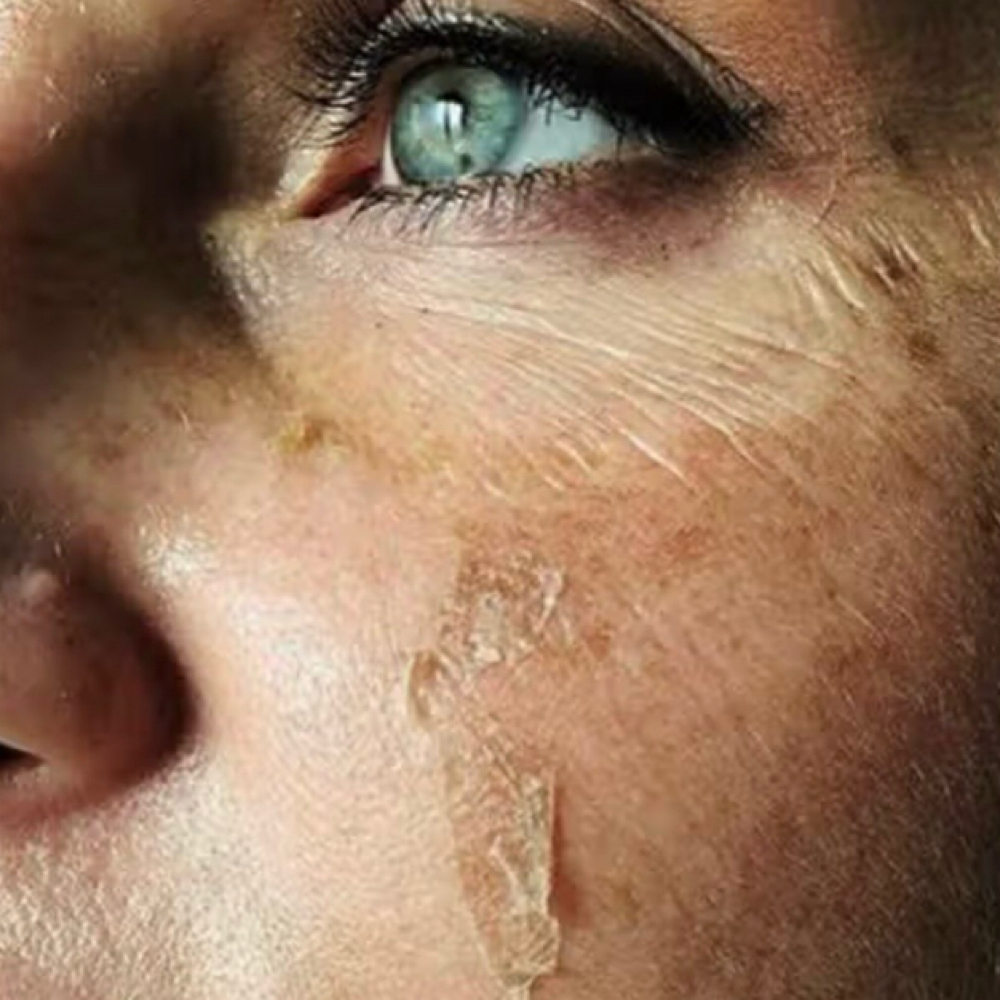 TCA Peel with Facial Treatment