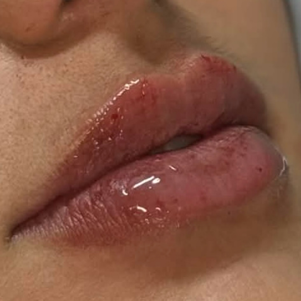 .5ML HALF SYRINGE •LIPS• at Glam X Sam MedBeauty in Andrews, TX