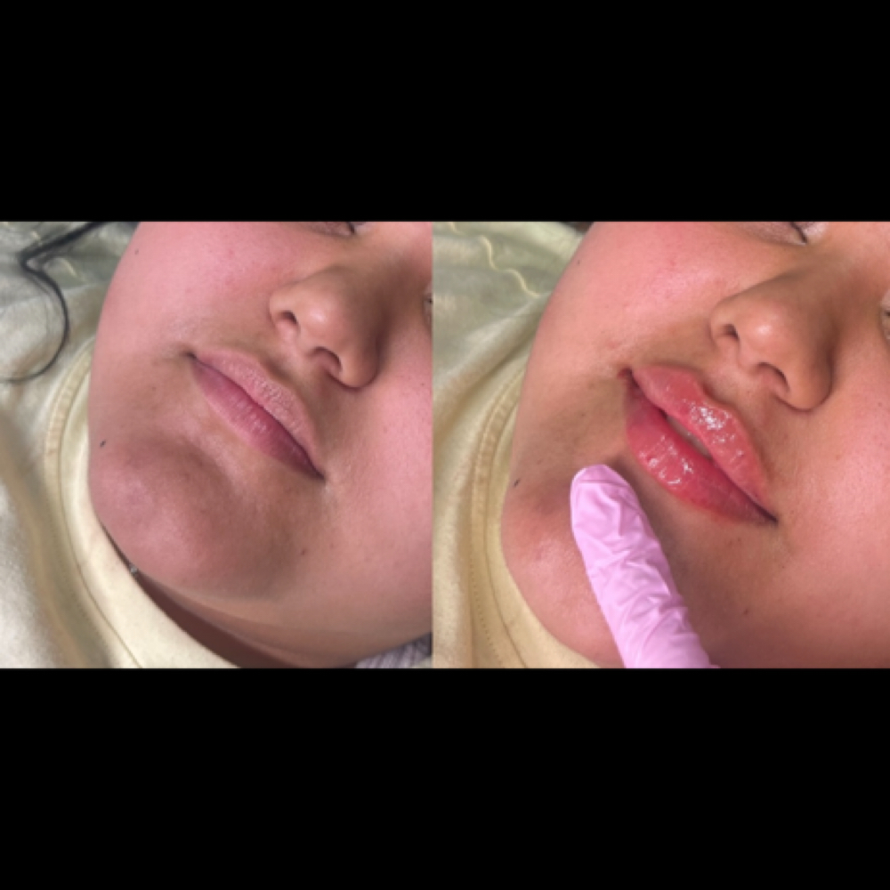 Half Syringe at Glam X Sam MedBeauty in Andrews, TX