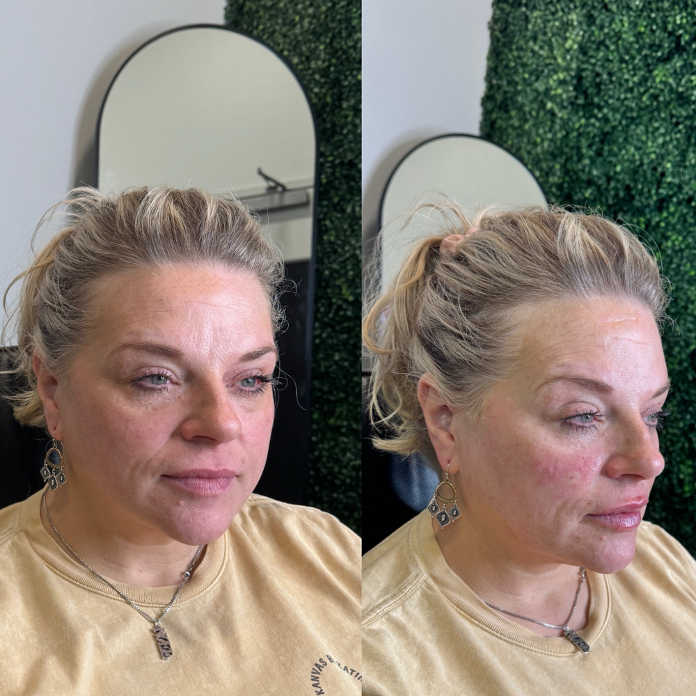 Nasal Labia  Fold Filler