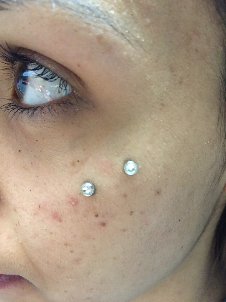 Double Micro-Dermal