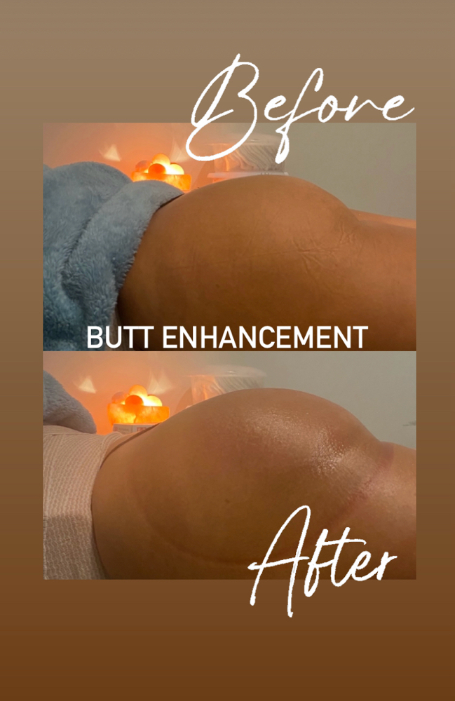 Non Invasive Butt Enhancement