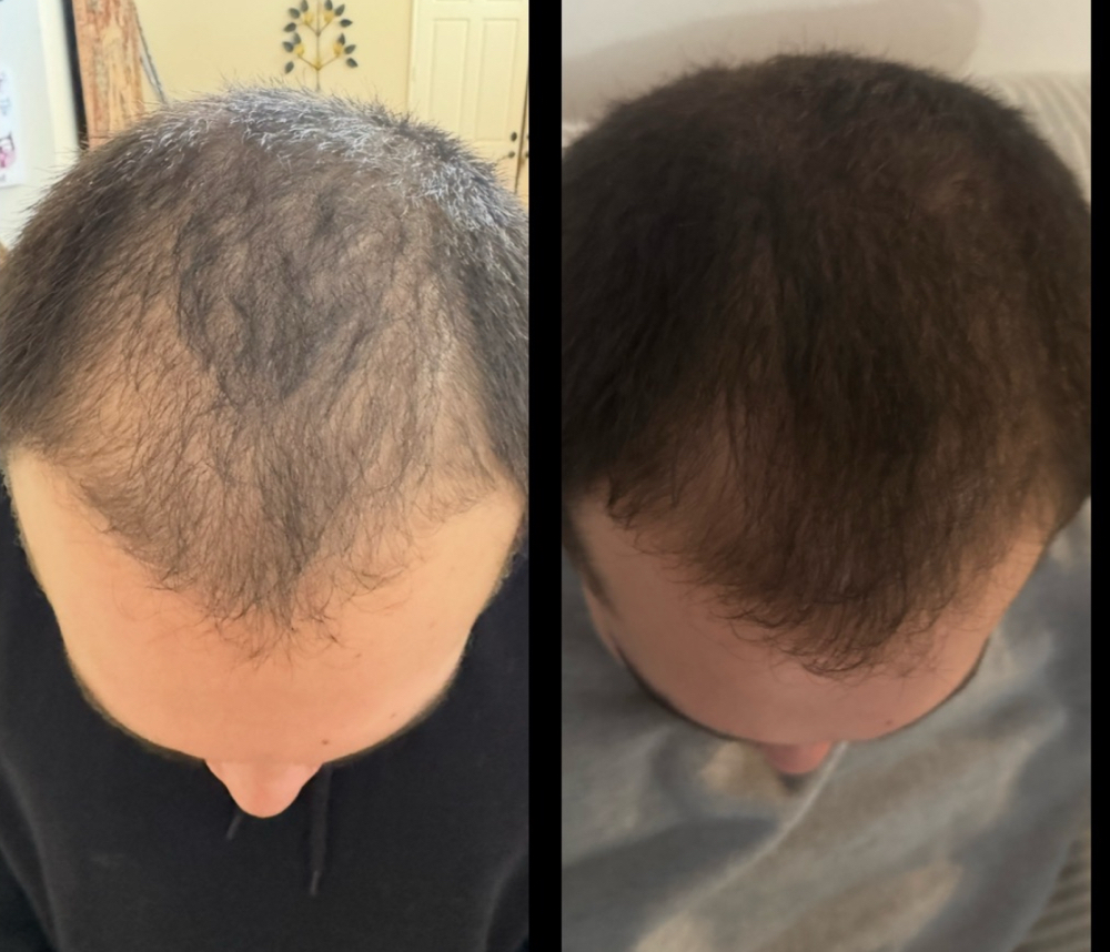 Hair Restoration