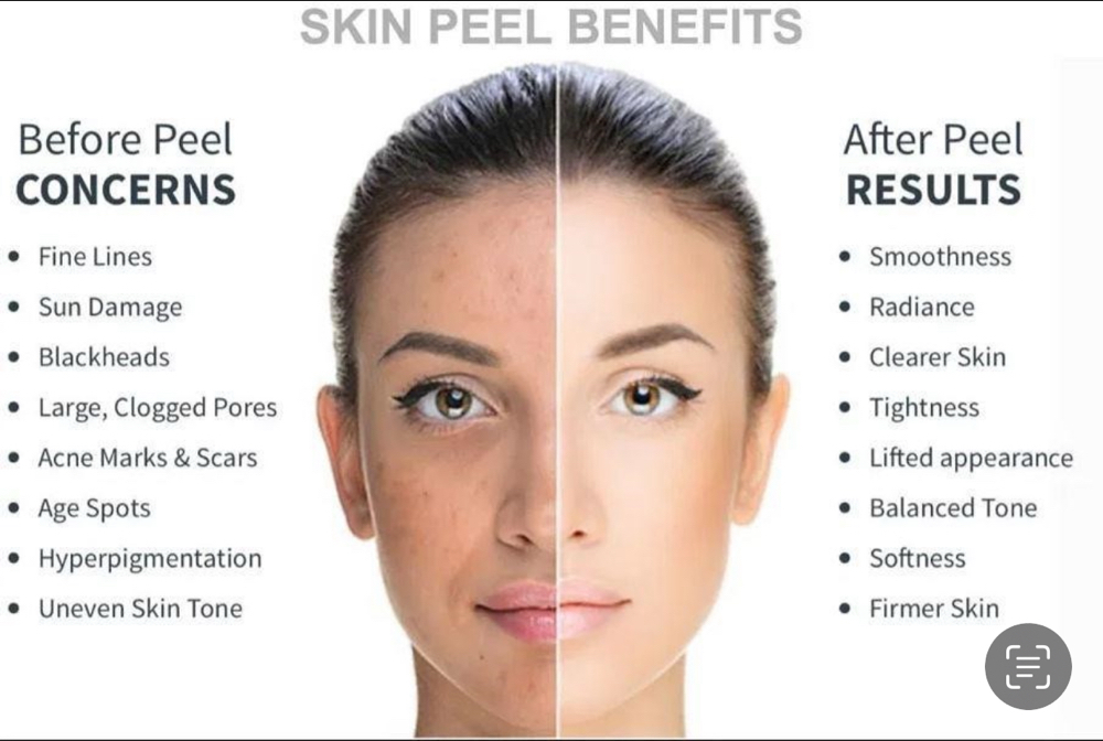 Chemical Peel