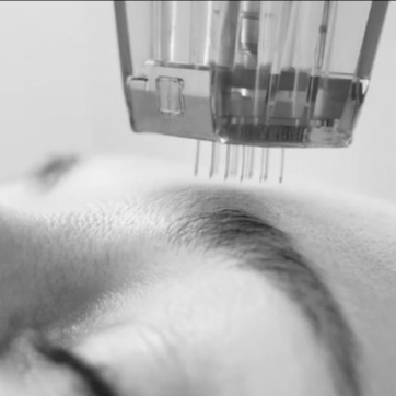 PRP Facial with Microneedling at Paige Fink Aesthetics in Orlando, FL