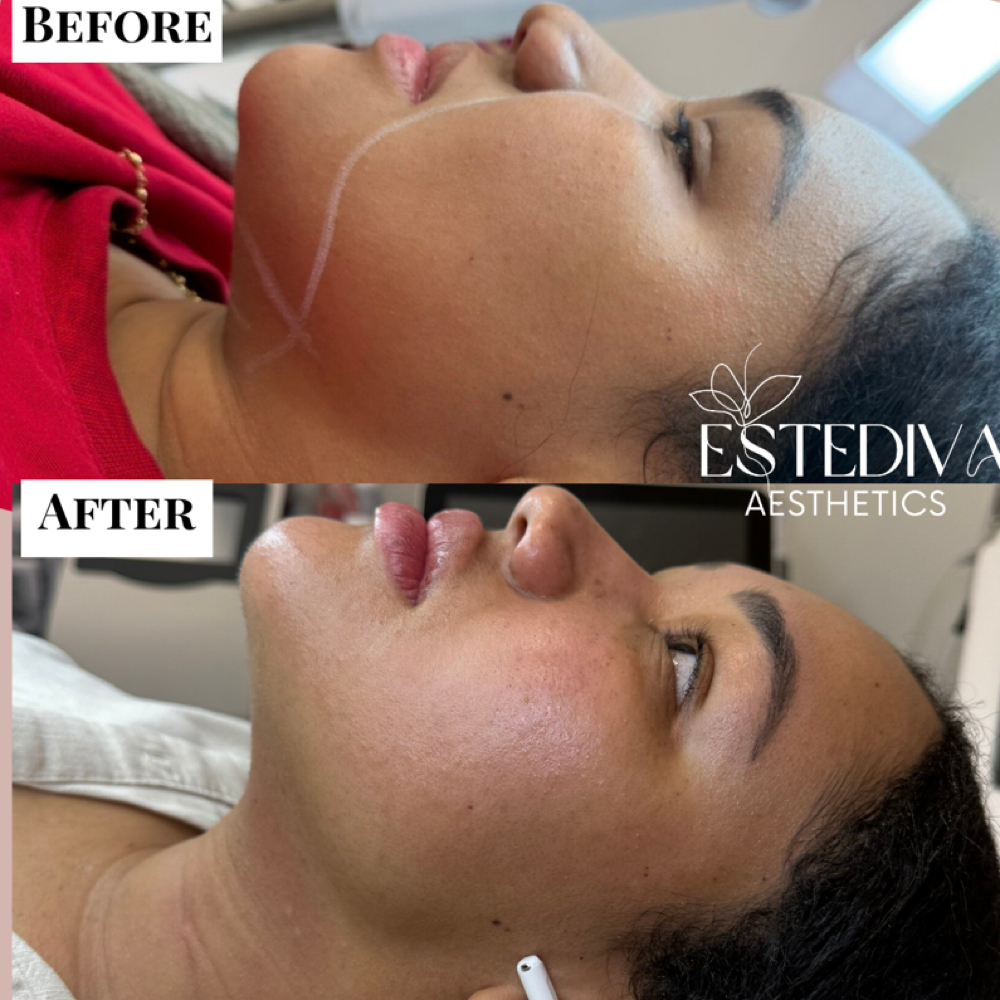 Double Chin & Jawline Contouring at Estediva Aesthetics in Long Island City, NY