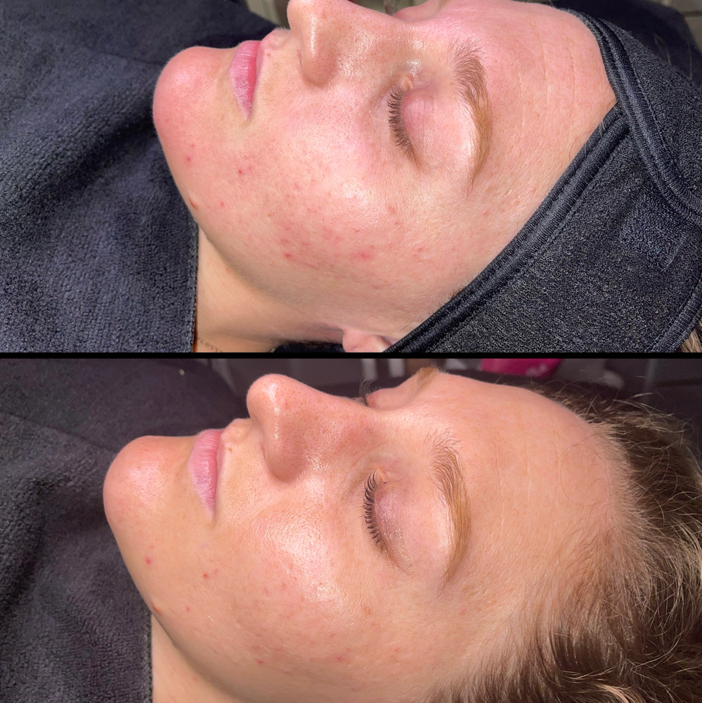 Chemical Peel