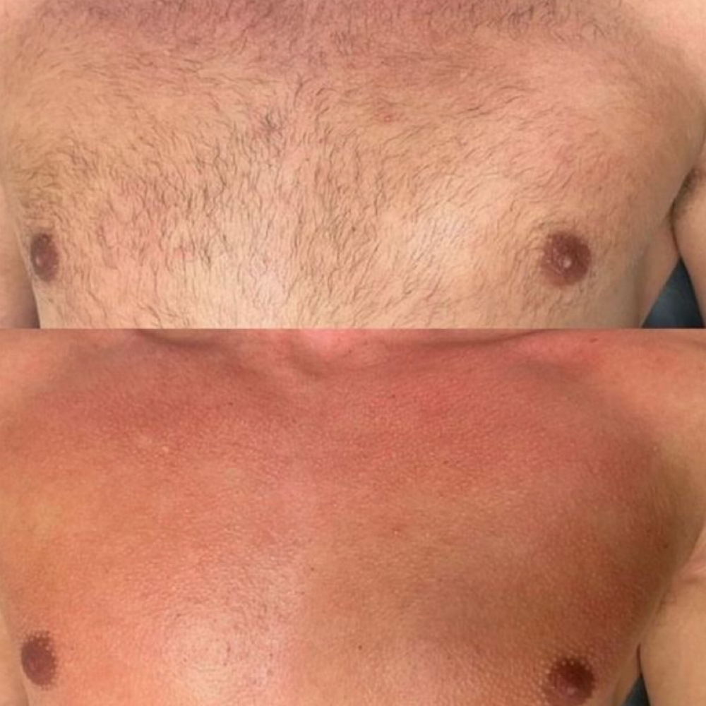 Full Chest Wax at LauLux Esthetics in Bellerose, NY