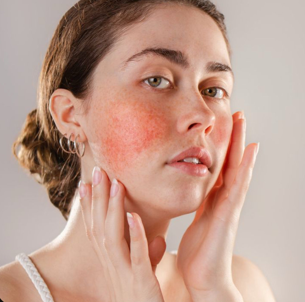 European Roscea Facial
