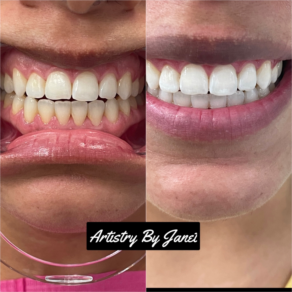 1.50 HR. Cosmetic Teeth Whitening