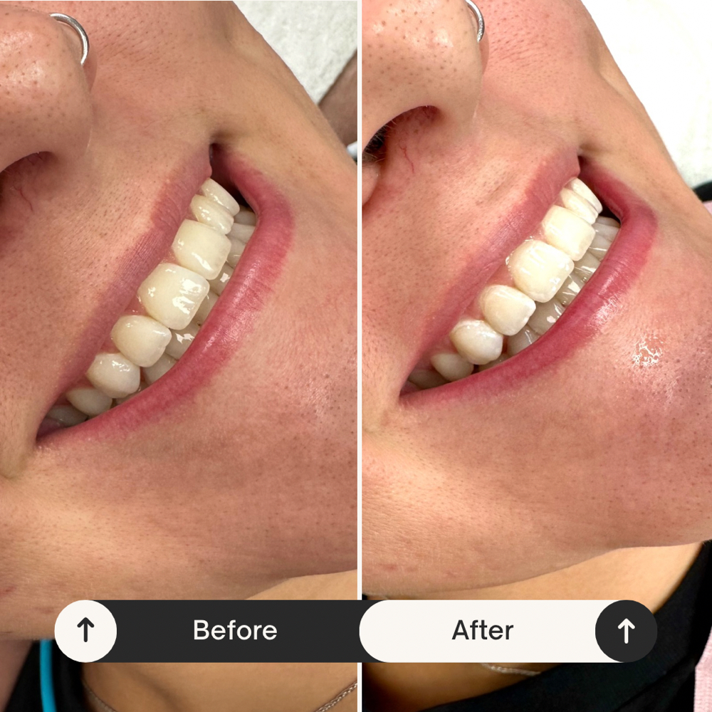 Teeth Whitening at The Beauty Nest in Chisago City, MN