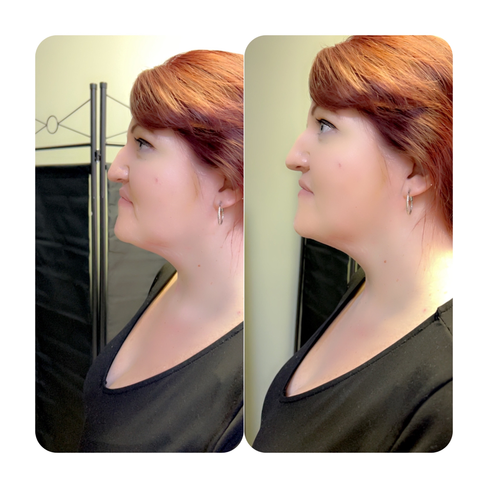 Chin Reduction