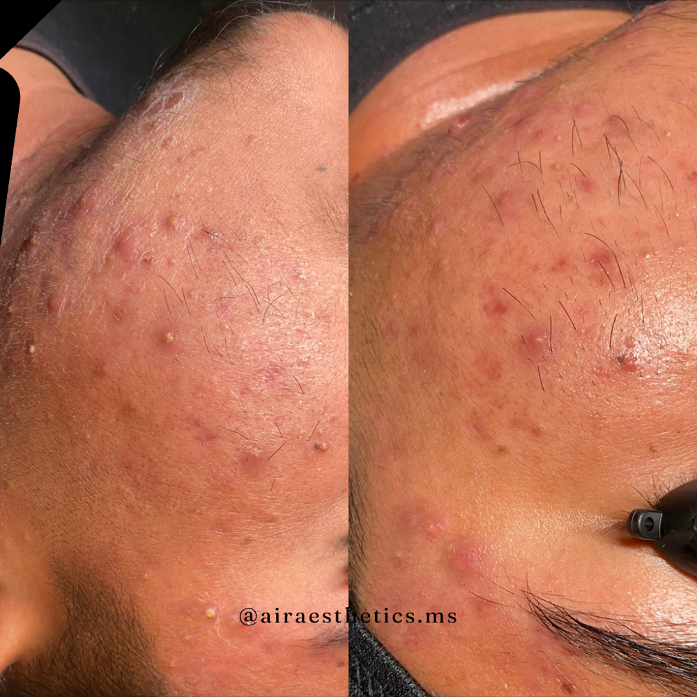 Face Reality Acne Facial