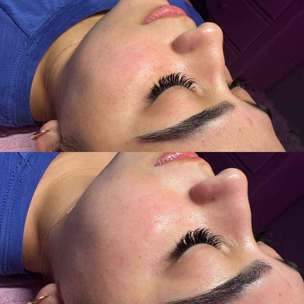 O2 Tox Peel Treatment