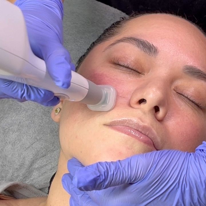 Jet Plasma at Zoraya Velez AESTHETICIAN in Richmond, VA