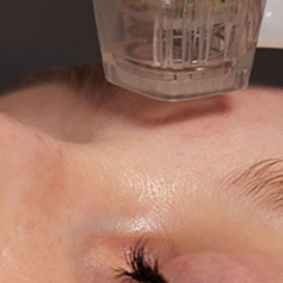 Radio Frequency Microneedling at Fade + Form Skin Aesthetics in Cartersville, GA