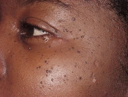 DPN Removal at ReBourne Aesthetics and Wellness in Ridgland, MS