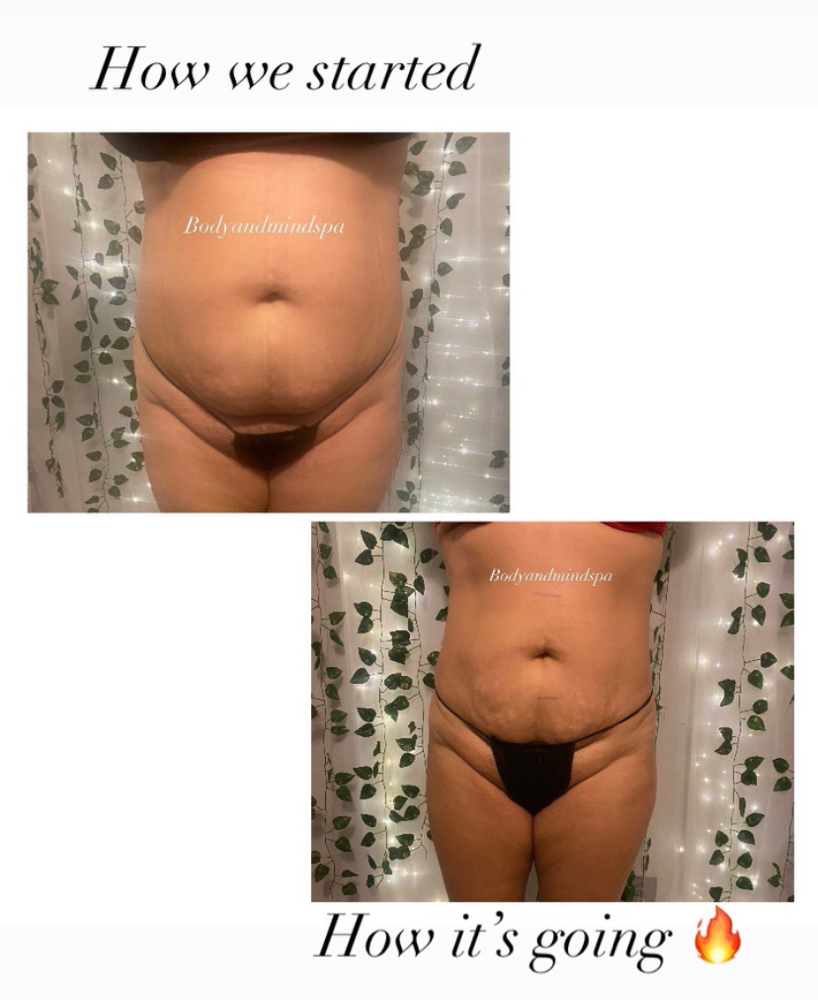 Fat Dissolvers Stomach 1session