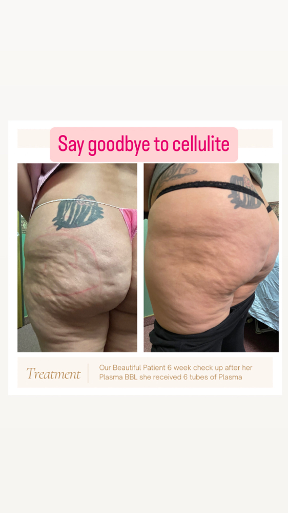 Plasma Cellulite Treatment