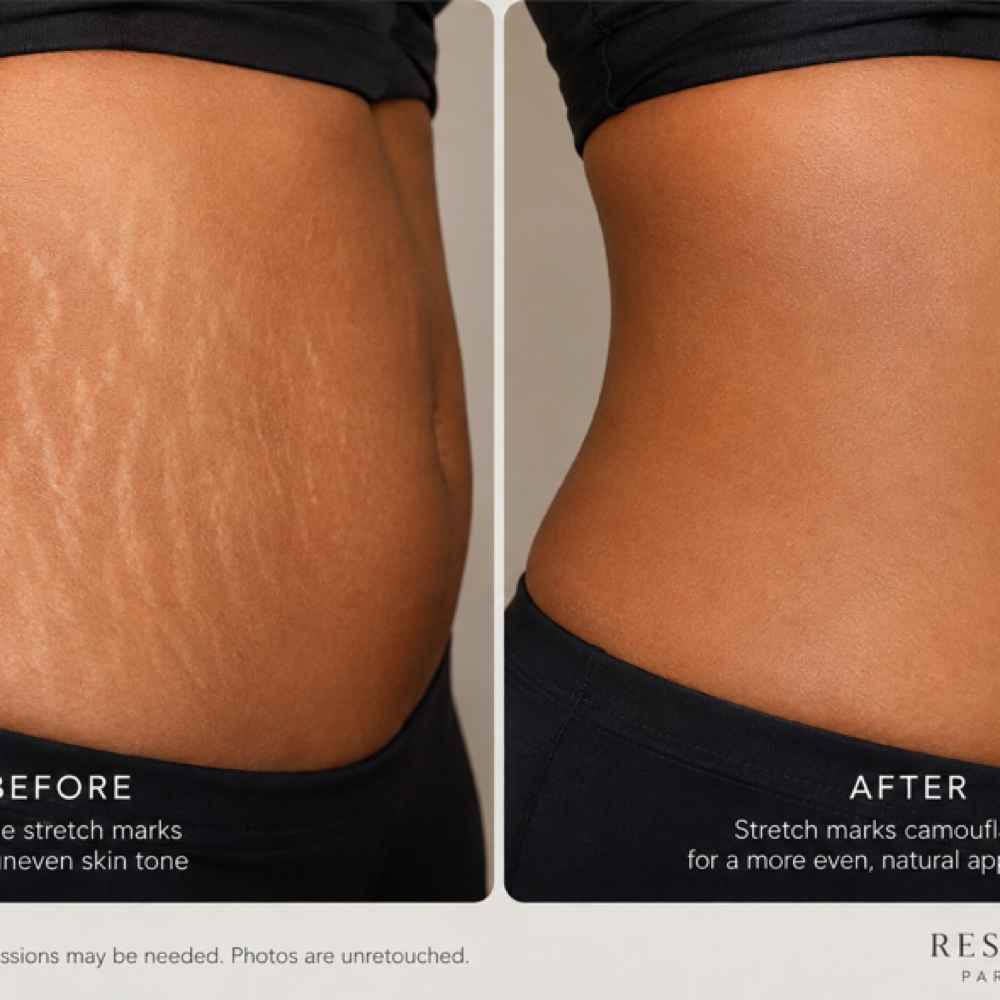 Waist Stretch Mark Camouflage at Restored Hue Paramedical Studio in Atlanta, GA