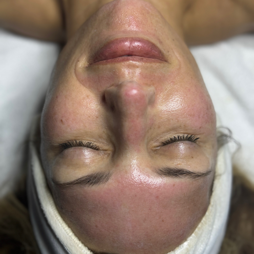 Microneedling Face at Bare Skin Aesthetics in West Palm Beach, FL