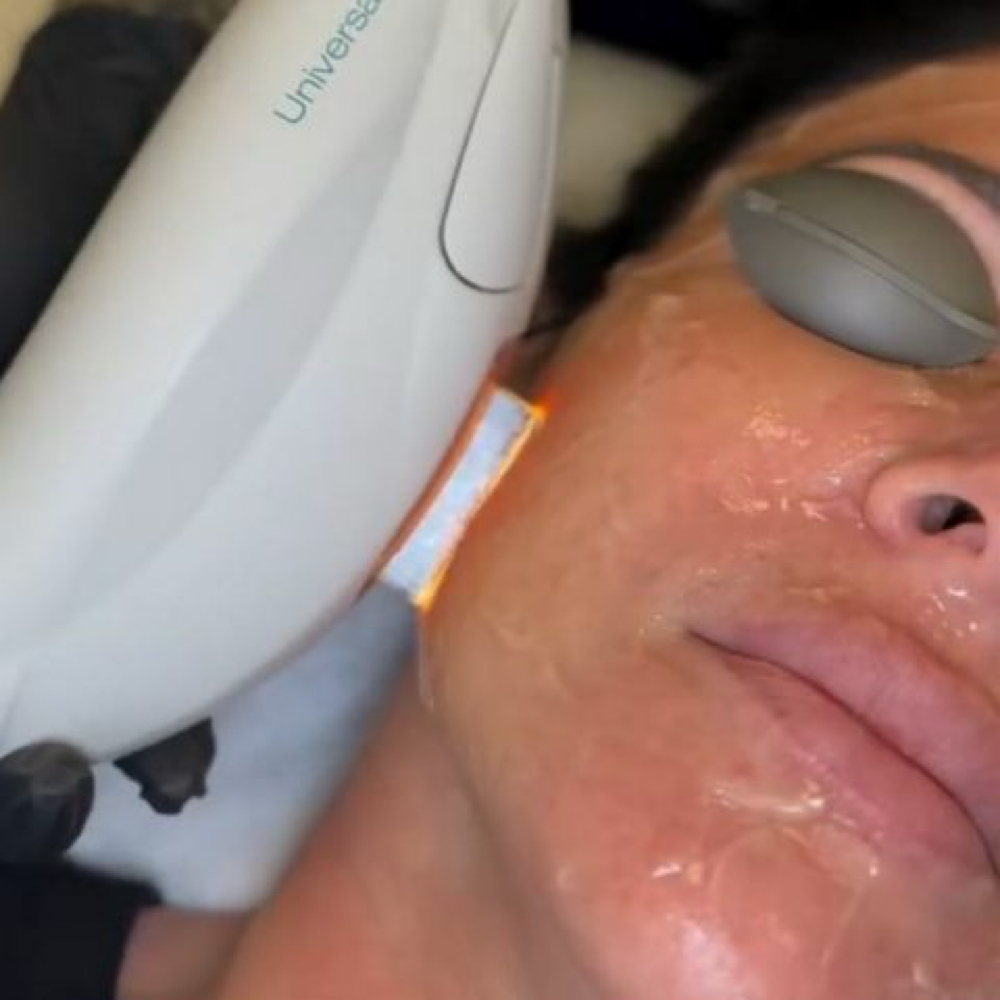 Ipl Photo Facial at Acnessia Laser Clinic in Guaynabo, PR