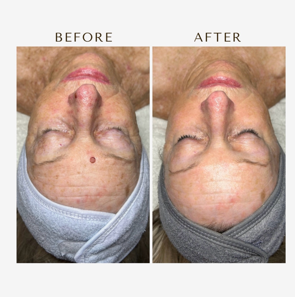 Ult. SWICH Dermal Revitalization
