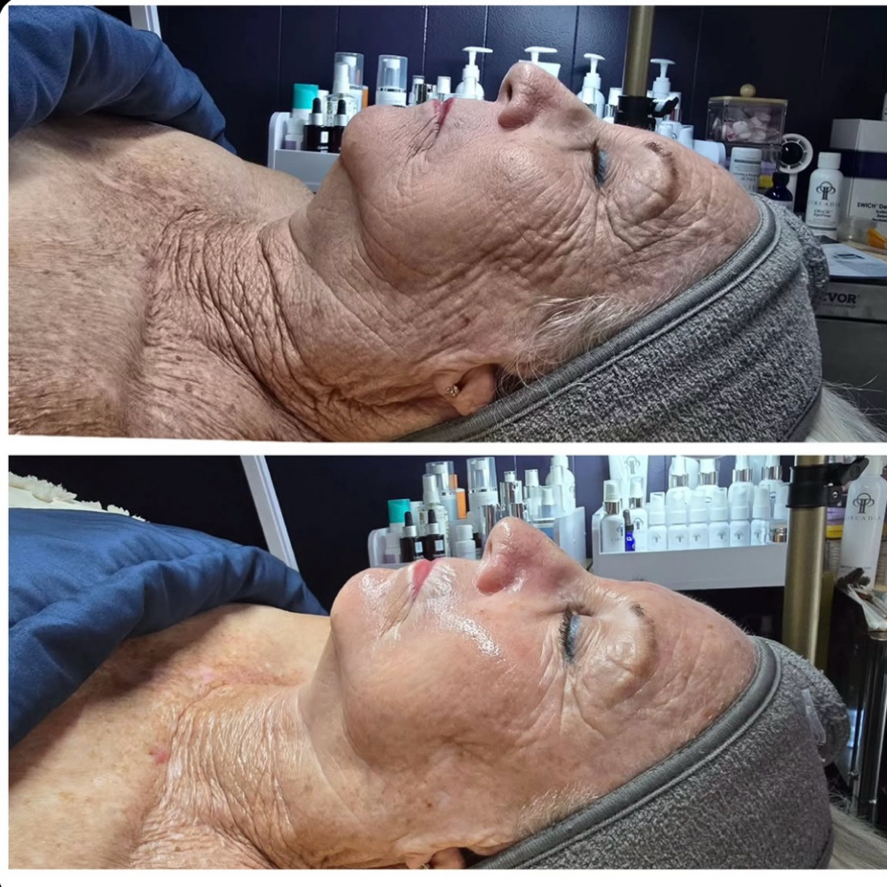 Ult. SWICH Dermal Revitalization at Haylee Jade Esthetics LLC in Ellijay, GA