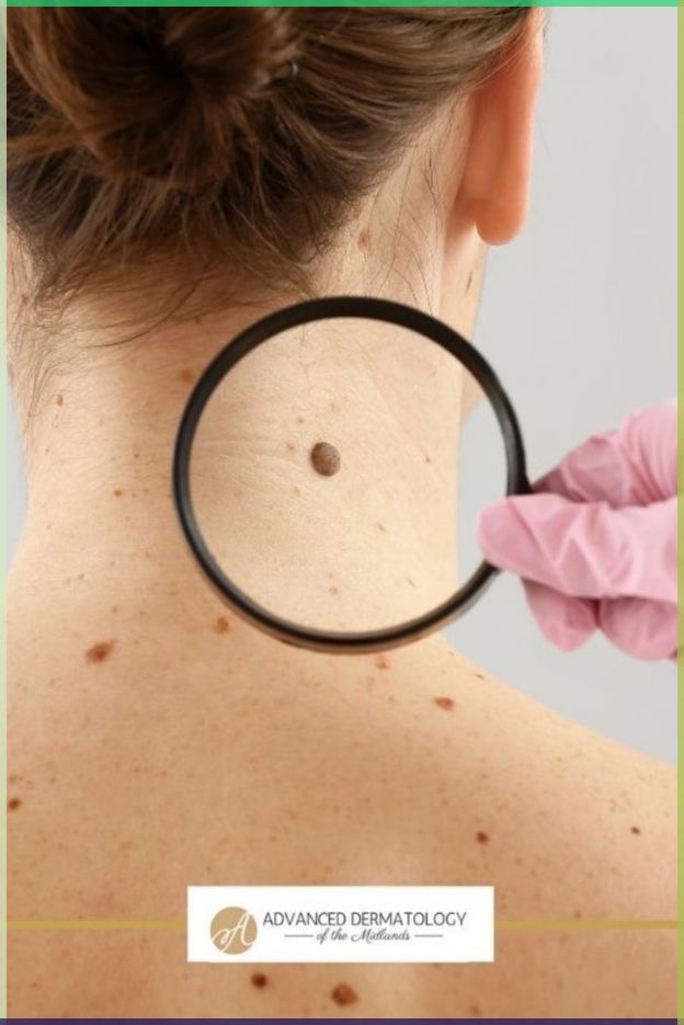 Remoción Skin Tags - Verugas (+6)