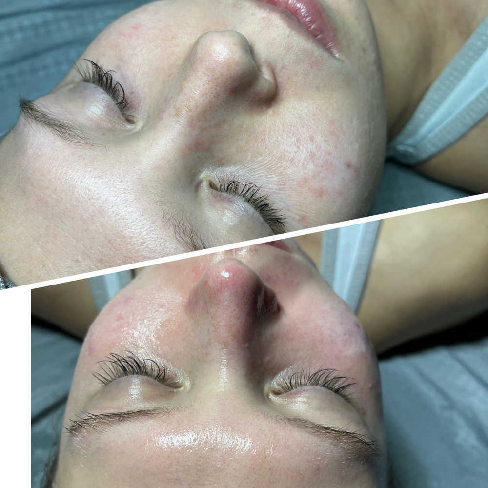 Hydra-Jelly Facial
