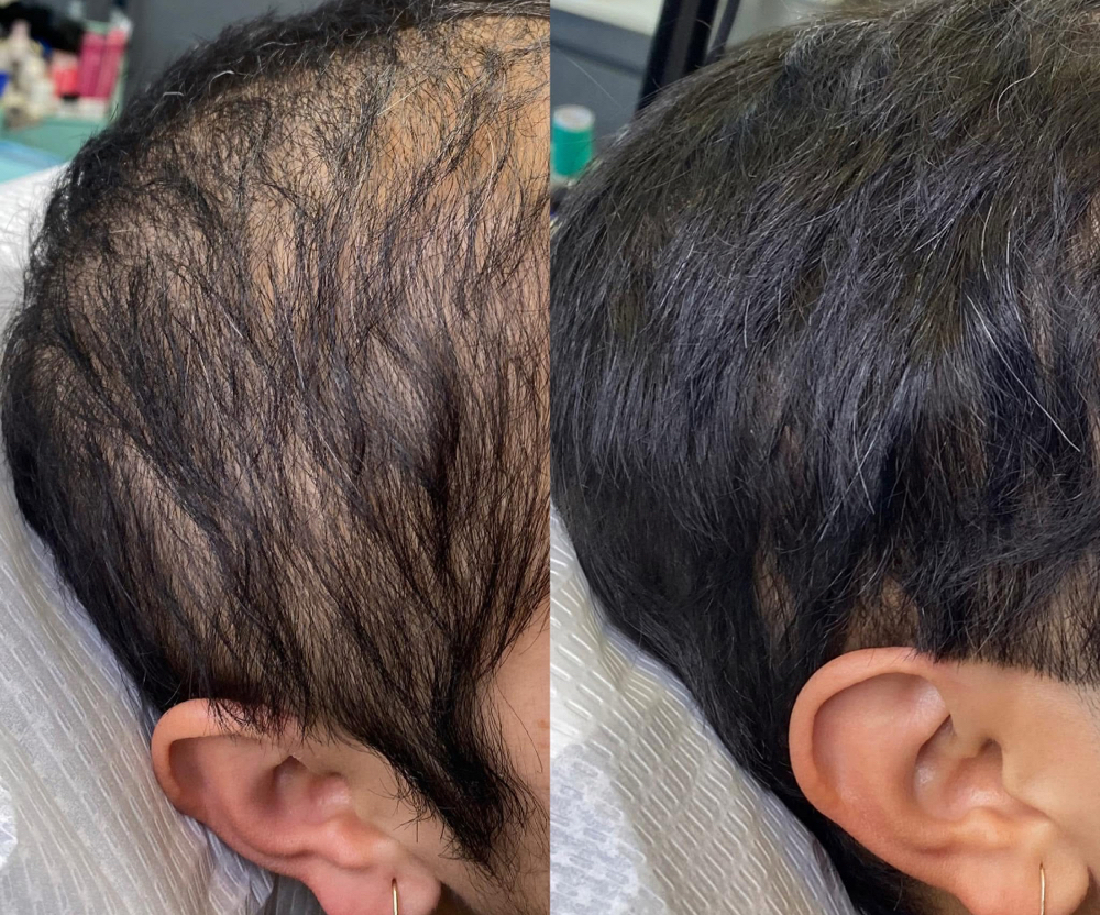 Hair Restoration